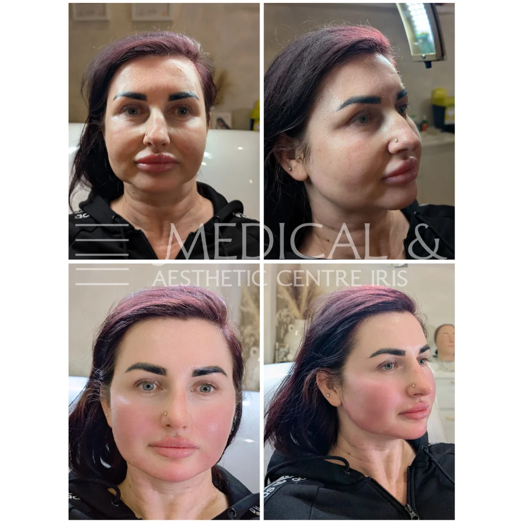 Botox -Full face lifting