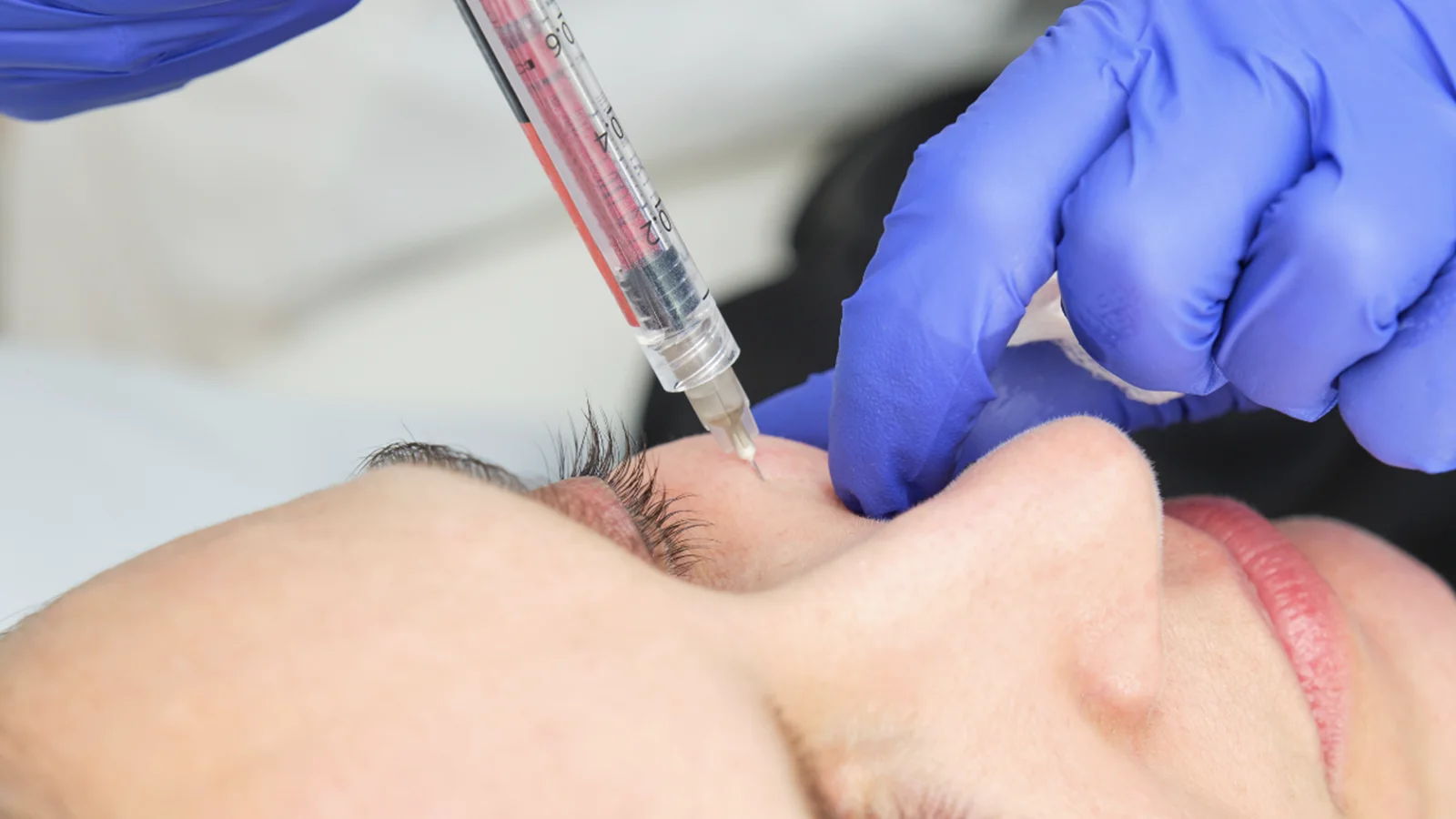 Fillers – Hyaluronic Acid – Advanced