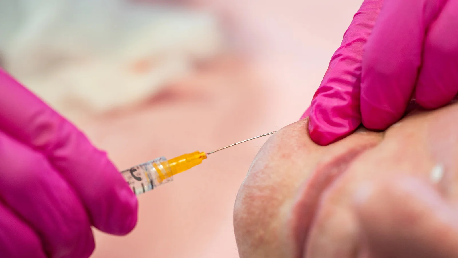 Biostimulators and Stimulators – cannula, points – BAP Basic