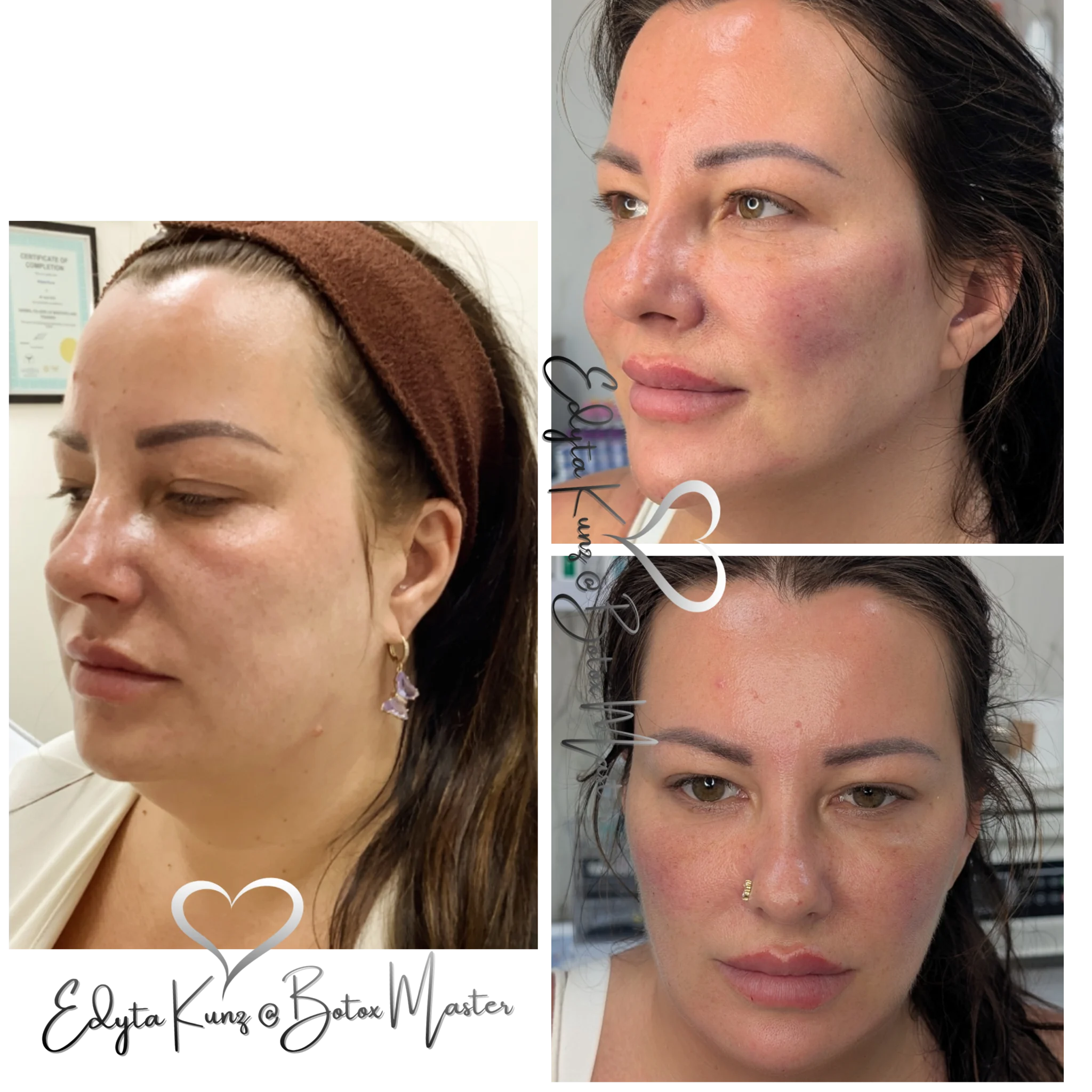 Full Face Concept -lifting twarzy kwasem hialuronowym