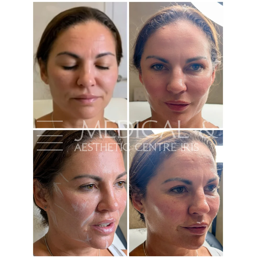 Full Face Concept -lifting twarzy kwasem hialuronowym