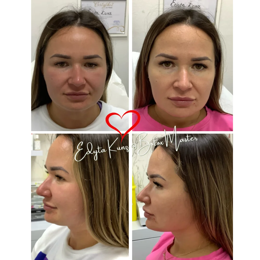 Full Face Concept -lifting twarzy kwasem hialuronowym
